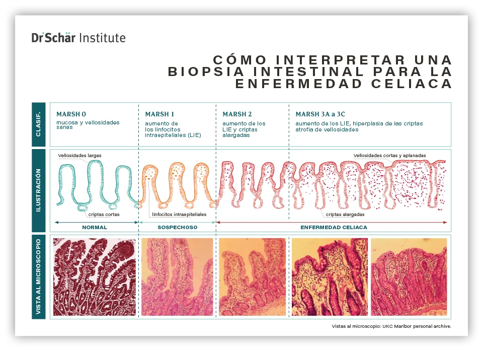 Gráfico que ilustra interpretaciones de biopsias intestinales relacionadas con la enfermedad celíaca, comparando hallazgos normales y anormales