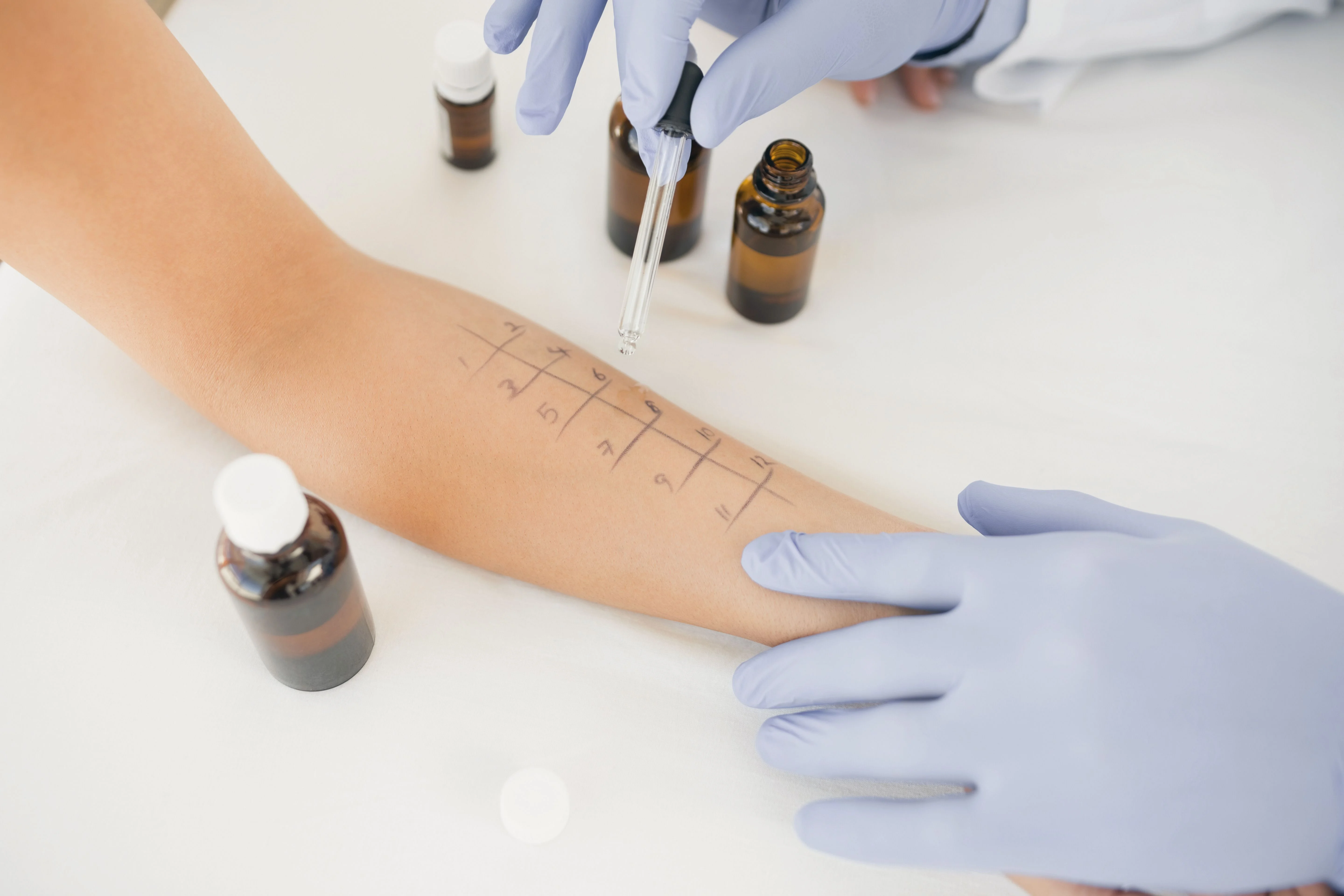 Mani guantate che applicano liquido da un contagocce su un braccio segnato per un test allergico, con bottiglie attorno