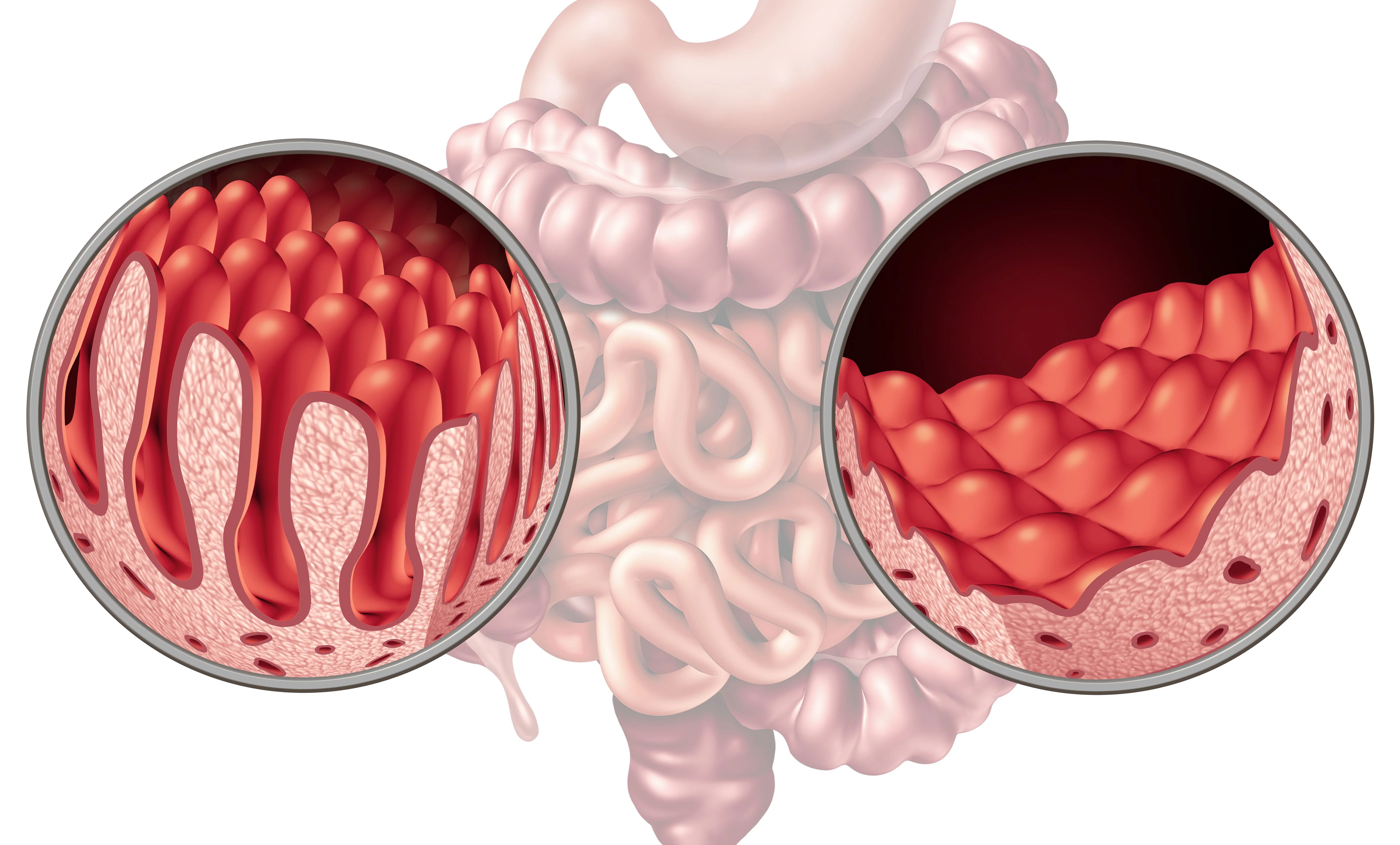 Detailed cross-section of the intestines, highlighting the contrasting texture of healthy and damaged tissue